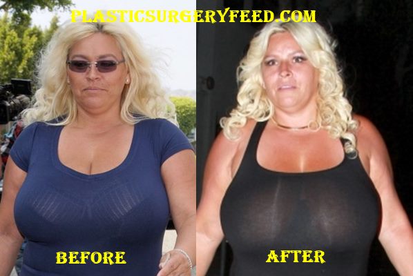Beth Chapman Breast Implants - Plastic Surgery Feed.