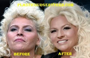 Beth Chapman Facelift and Botox