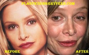 Calista Flockhart Lips Surgery