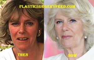 Camilla Parker Bowles Botox