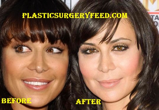 Catherine Bell Facelift