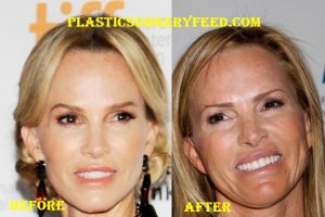 Janet Gretzky Facelift Plastic Surgery