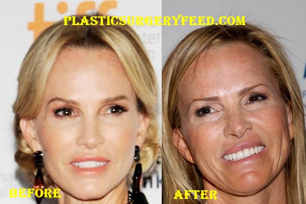 Janet Gretzky Facelift Plastic Surgery