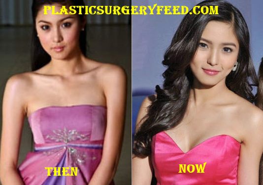 Kim Chiu Breast Implant