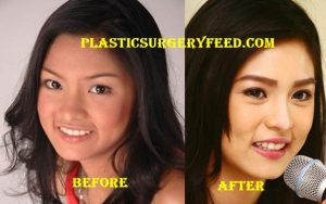 Kim Chiu Nose Job Rhinoplasty