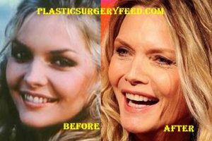 Michelle Pfeiffer Nose Job Rhinoplasty