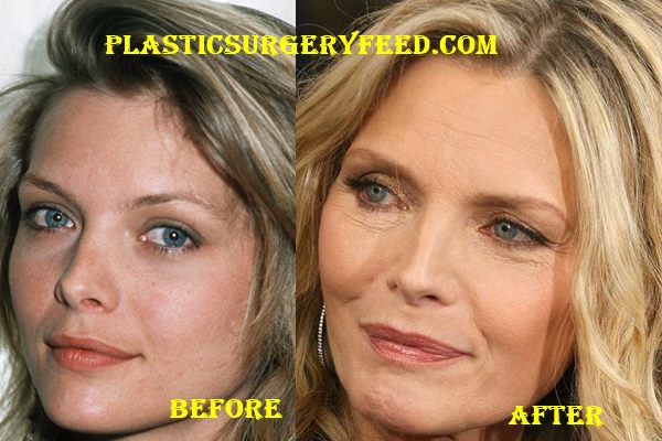 Michelle Pfeiffer facelift
