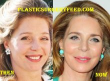 Queen Noor Favcelift and Botox Surgery