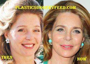 Queen Noor Favcelift and Botox Surgery