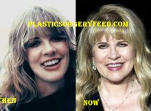 Stevie Nicks Botox and Facelift
