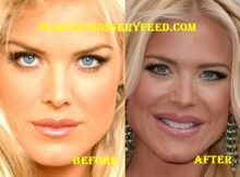 Victoria Silvstedt Lips Surgery