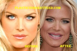 Victoria Silvstedt Lips Surgery