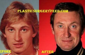 Wayne Gretzky Facelift Surgery