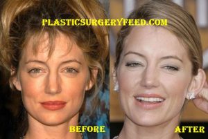 Cynthia Watros Nose Job Rhinoplasty