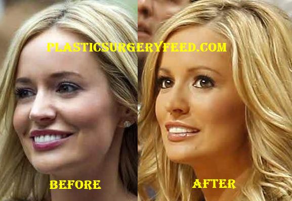 Emily Maynard Nose Job Rhinoplasty