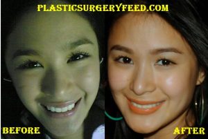 Heart Evangelista Cheek Implants