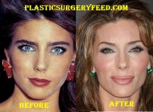 Jennifer Flavin Stallone Botox
