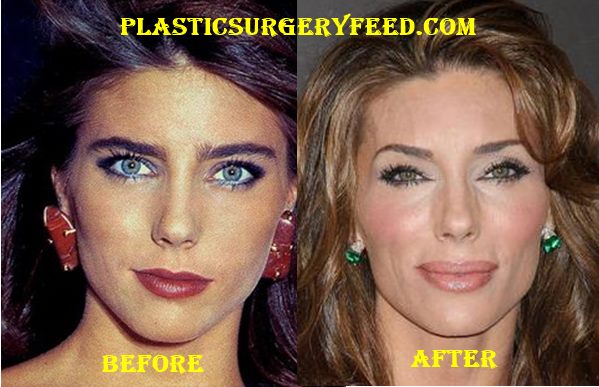 Jennifer Flavin Stallone Botox