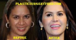 Jinkee Pacquiao Mini Facelift