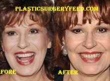 Joy Behar Botox and Facelift