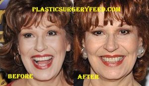 Joy Behar Botox and Facelift