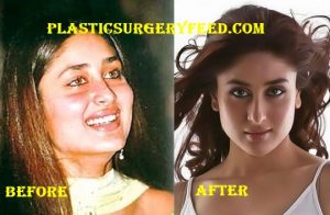 Kareena Kapoor Breast Implants