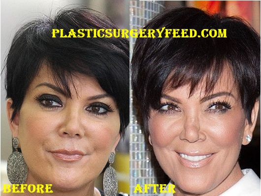 Kris Jenner Nose Job Rhinoplasty