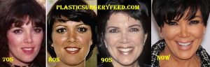 Kris Jenner Surgery Transformations