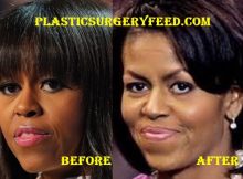 Michelle Obama Botox