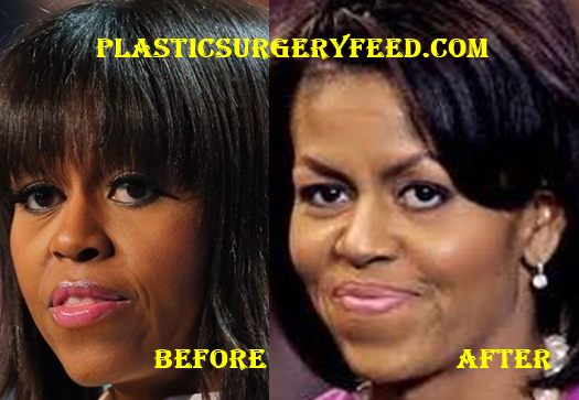 Michelle Obama Botox