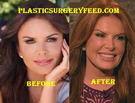 Roma Downey Botox