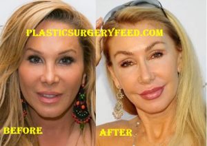 Adrienne Maloof Botox and Filler