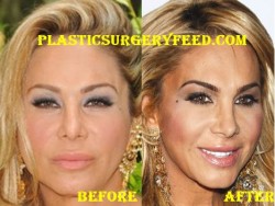 Adrienne Maloof Nose Job