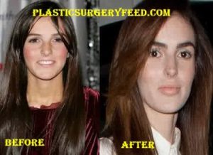 Ali Lohan Botox