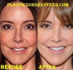Christa Miller Botox Facelift Before After