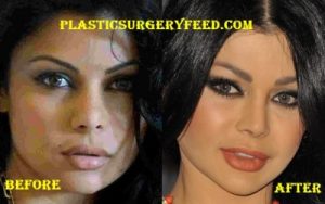 Haifa Wehbe Chin Implant