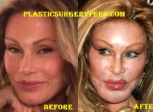 Jocelyn Wildenstein Before Plastic Surgery