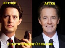 Kyle MacLachlan Botox and Facelift