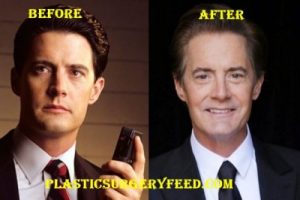 Kyle MacLachlan Botox and Facelift