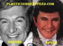 Liberace Plastic Surgery Before After