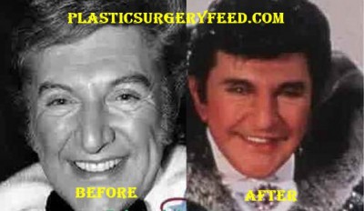 Liberace Plastic Surgery Before After