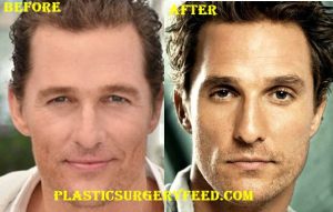 Matthew McConaughey Hair Transplant