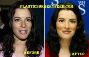 Nigella Lawson Botox