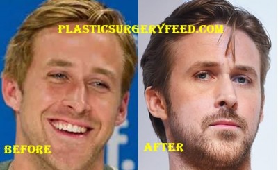 Ryan Gosling Nose Job Rhinoplastsy