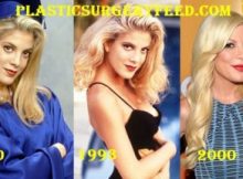 Tori Spelling Botox and Facelift 1990-2000