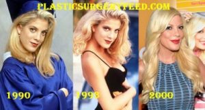 Tori Spelling Botox and Facelift 1990-2000