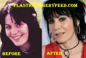 Joan Jett Botox