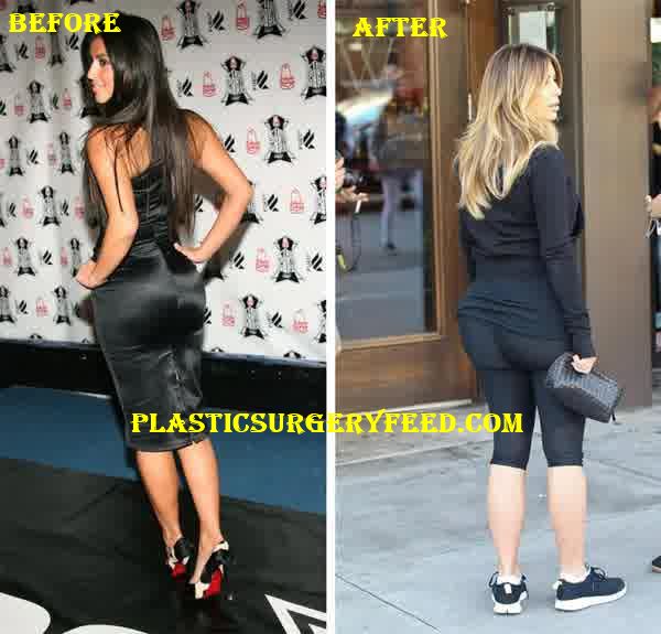 Kim Kardashian Butt Implants