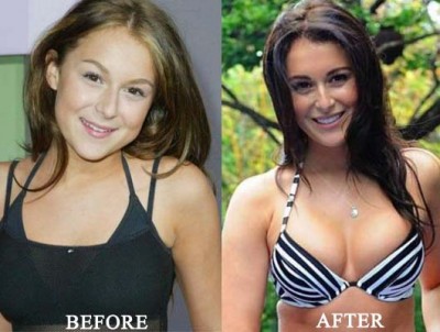 Alexa Vega Breast Implants