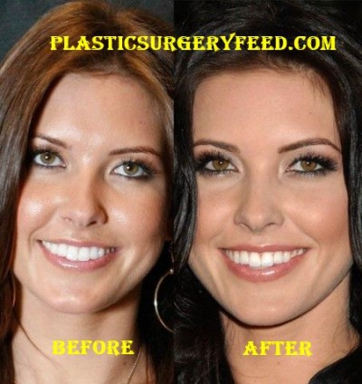 Audrina Patridge Nose Job, Lip and Chin Implants